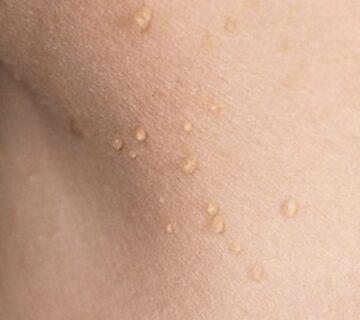 How Skin Tags are Removed Using Electrolysis